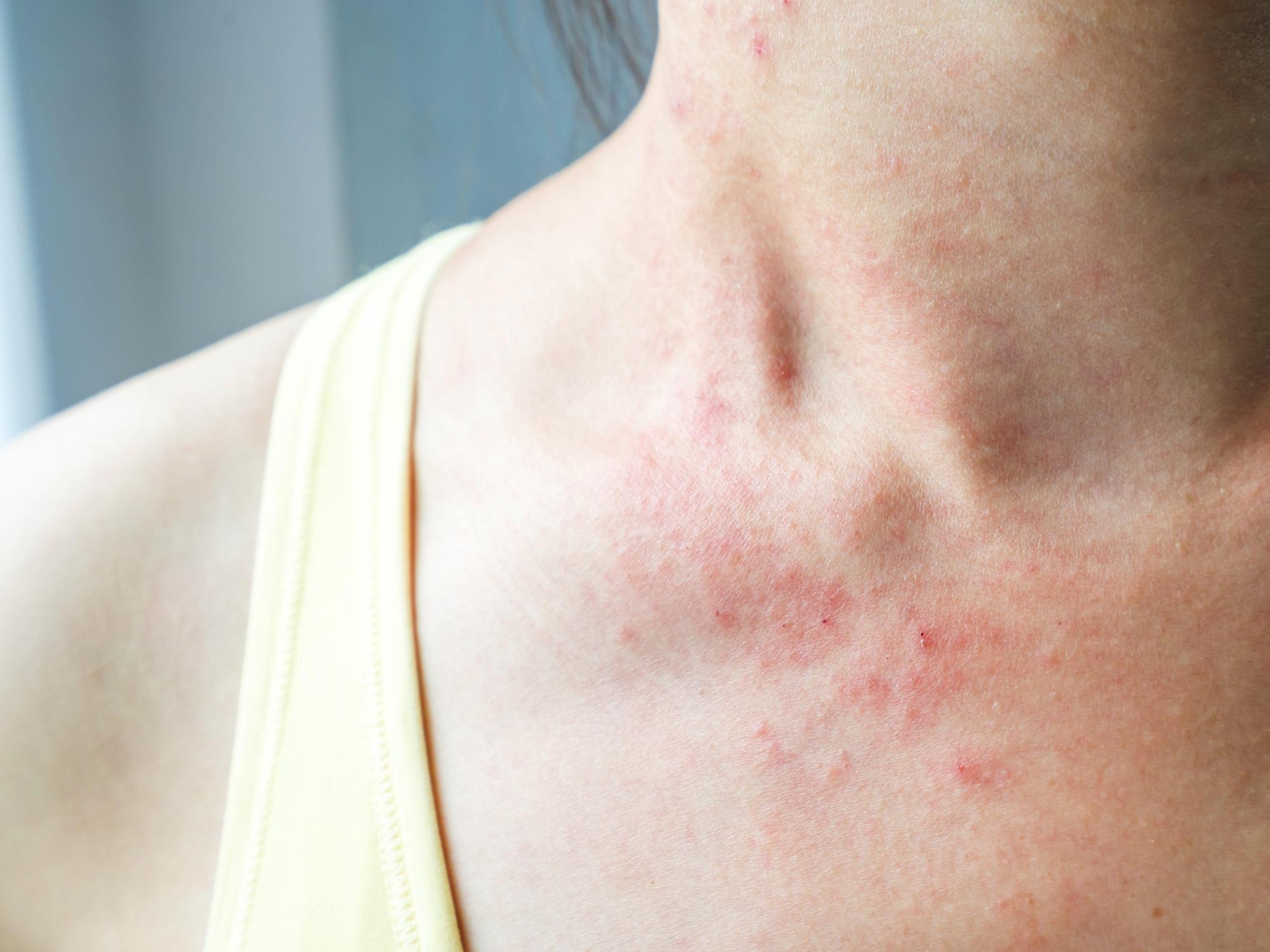 6 simple tips to prevent eczema flare