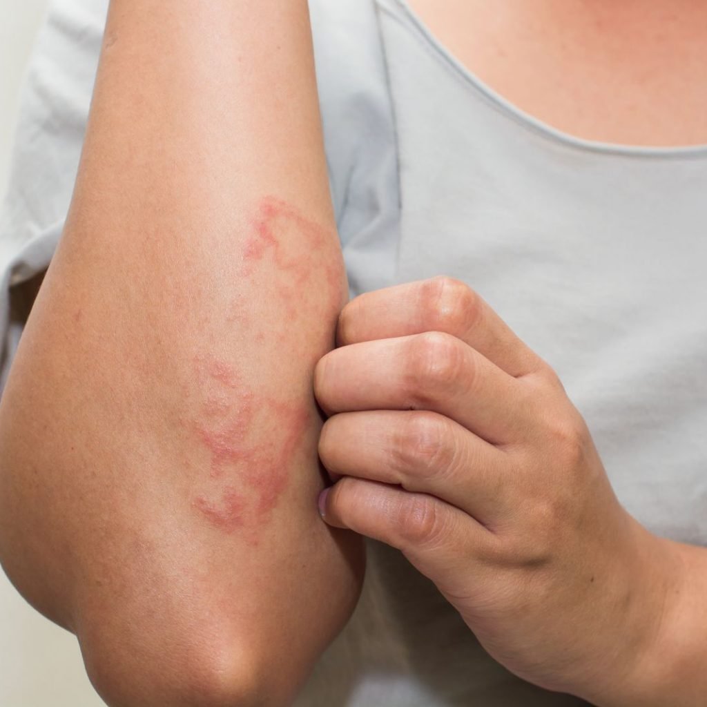 6 Tips to deal with Eczema Flare