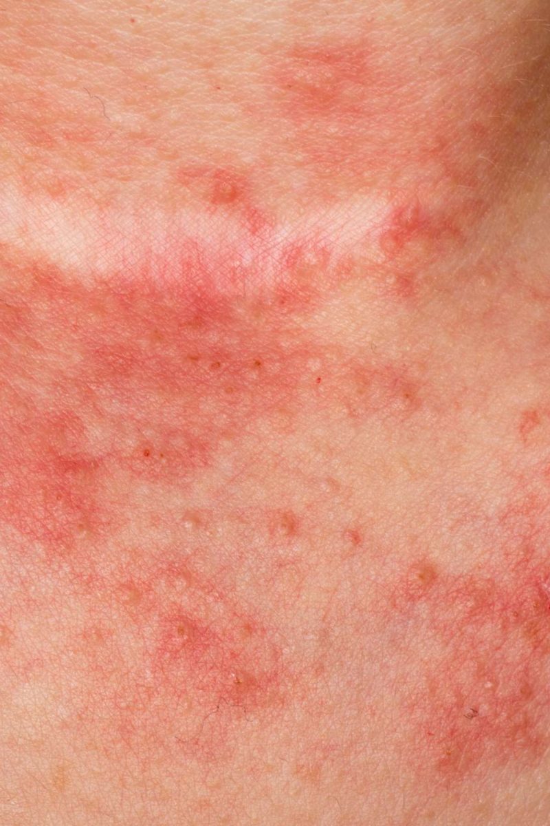 6 types of eczema: Symptoms and causes
