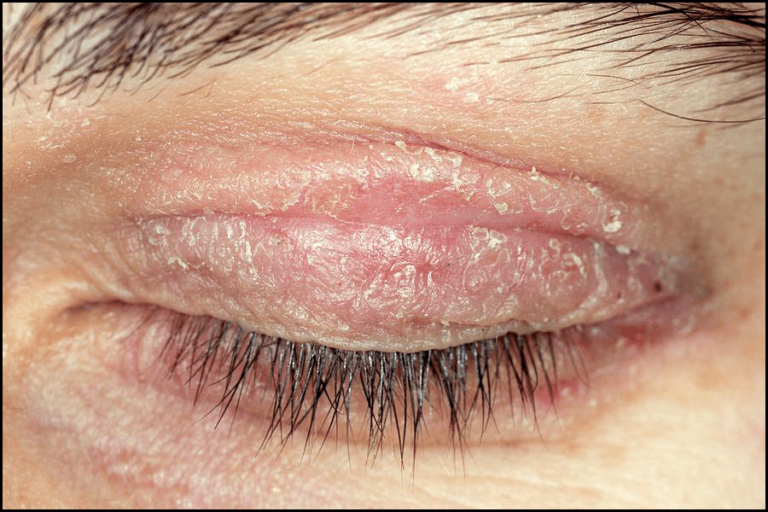 7 Causes and Effective Home Remedies to Get Rid of Eyelid Rashes