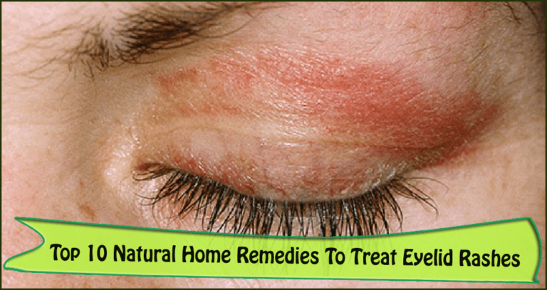 7 Causes and Effective Home Remedies to Get Rid of Eyelid ...