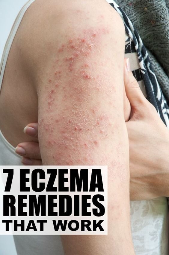 7 eczema remedies that work