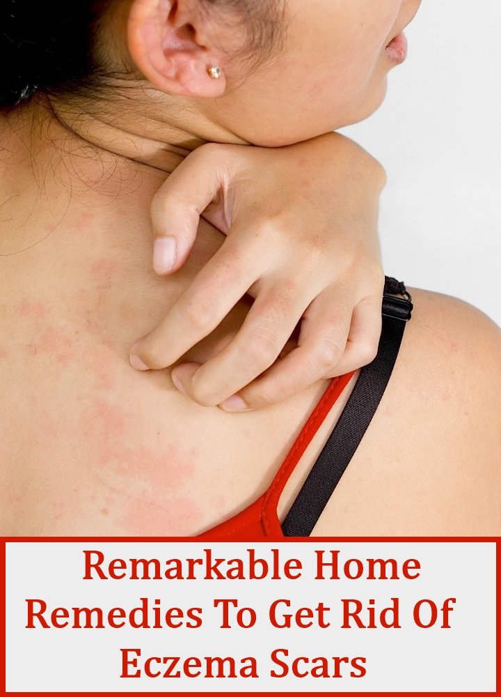 7 Remarkable Home Remedies To Get Rid Of Eczema Scars ...
