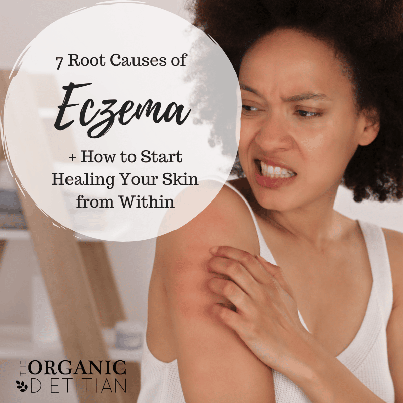 7 Root Causes of Eczema + How to Start Healing Your Skin from Within ...