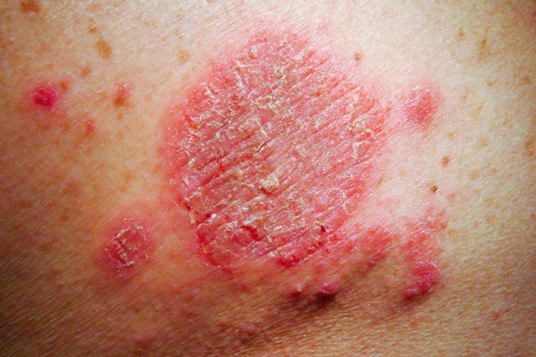 7 Skin Conditions That Can Be Mistaken for Ringworm ...