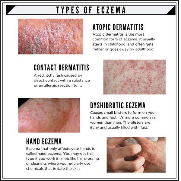 7 TYPES OF ECZEMA AND ITS SYMPTOMS
