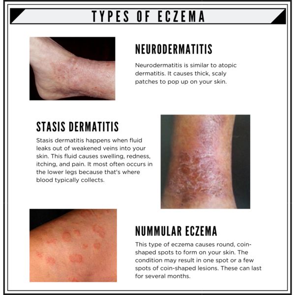 7 TYPES OF ECZEMA AND ITS SYMPTOMS in 2021