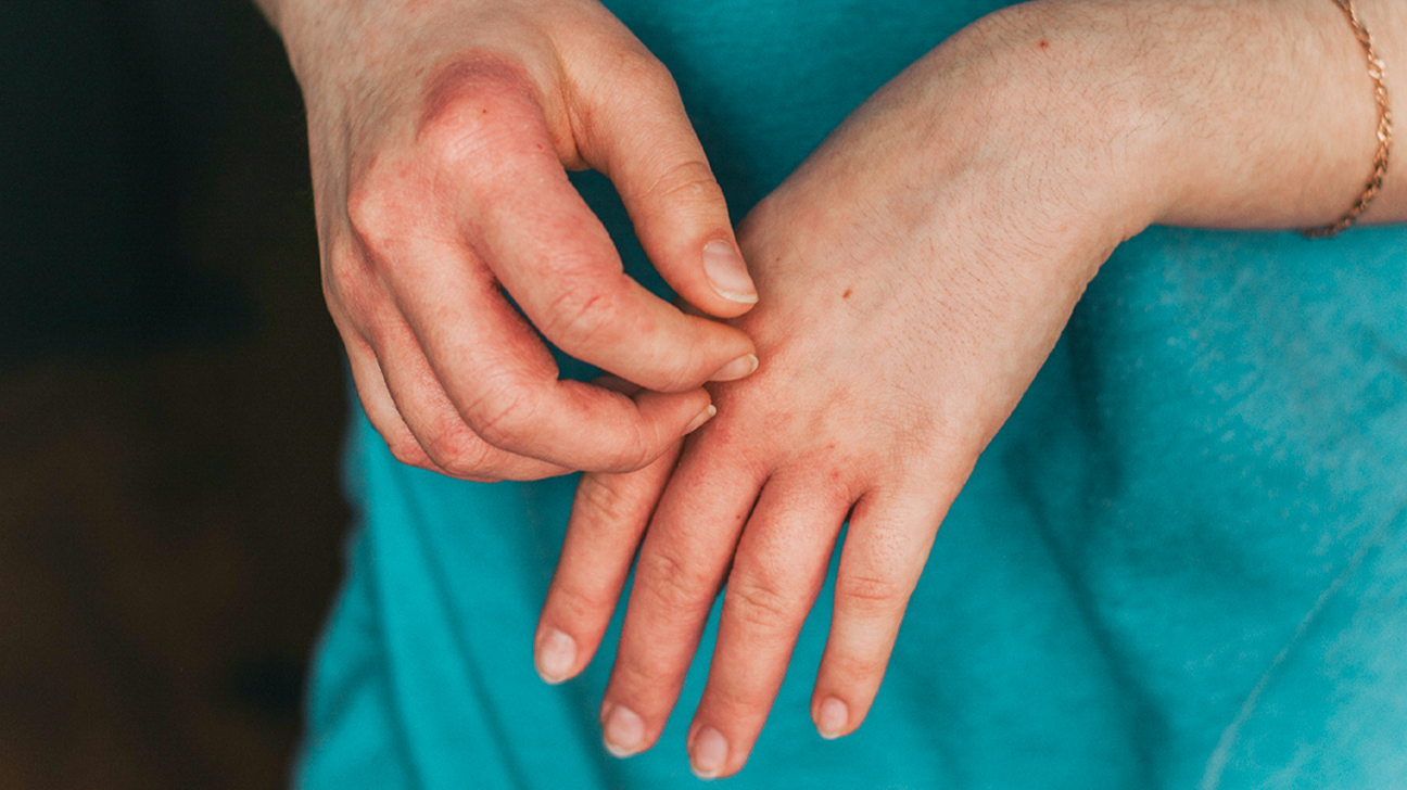 7 Types of Eczema: Symptoms, Causes, and Pictures