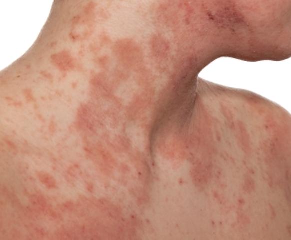 8 Eczema Symptoms to Look Out For