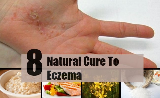 8 Effective Natural Cures For Eczema