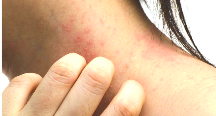 8 Home Treatments To Specifically Fight Your Worst Eczema Flare Up