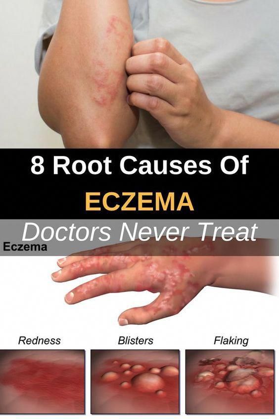 8 Root Causes Of Eczema Doctors Never Treat # ...