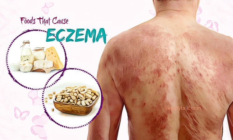 9 Common Foods That Cause Eczema Outbreaks Or Make It Worse