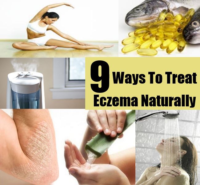 9 Ways To Treat Eczema Naturally