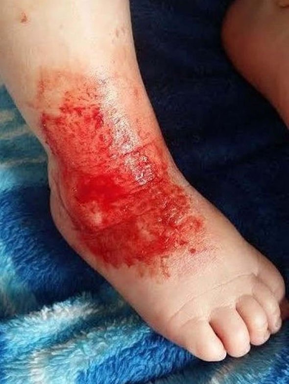 A baby struggles with ECZEMA so badly his legs bleed and ...