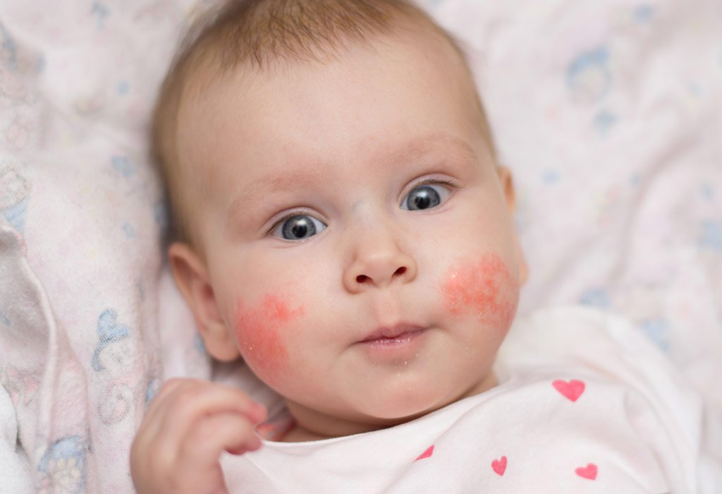 A baby with rashes on the face