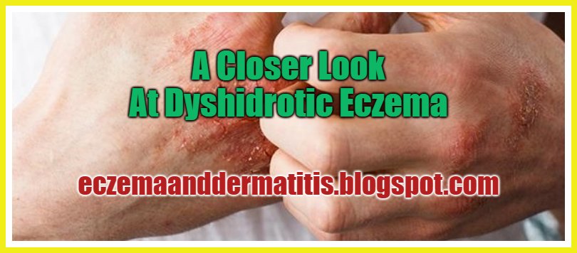 A Closer Look At Dyshidrotic Eczema
