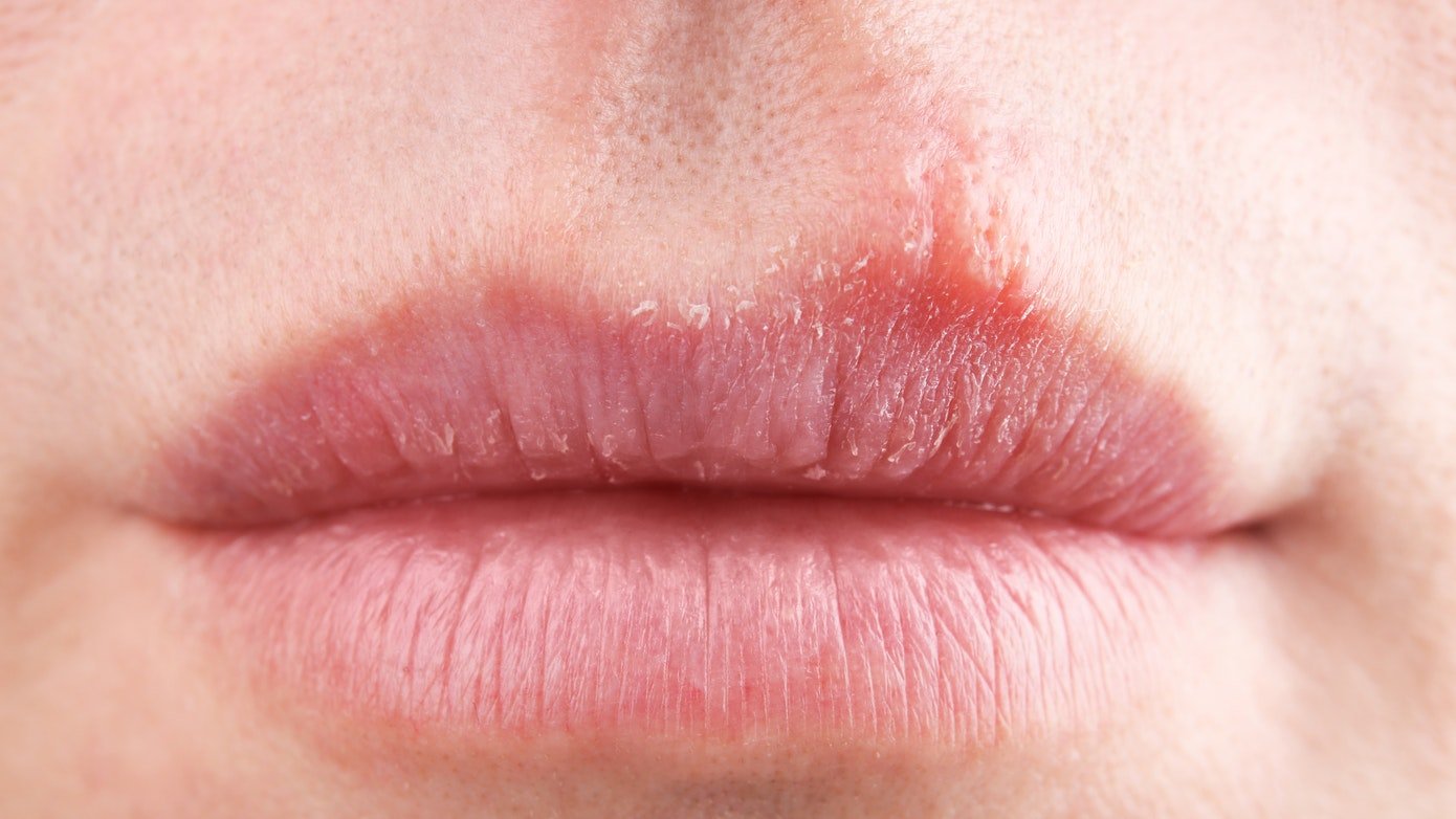A Closer Look at Lip Eczema  Why Wont Anybody Kiss Me?  Tadakaluri