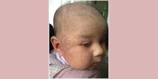 A four month old baby girl with severe eczema is treated ...