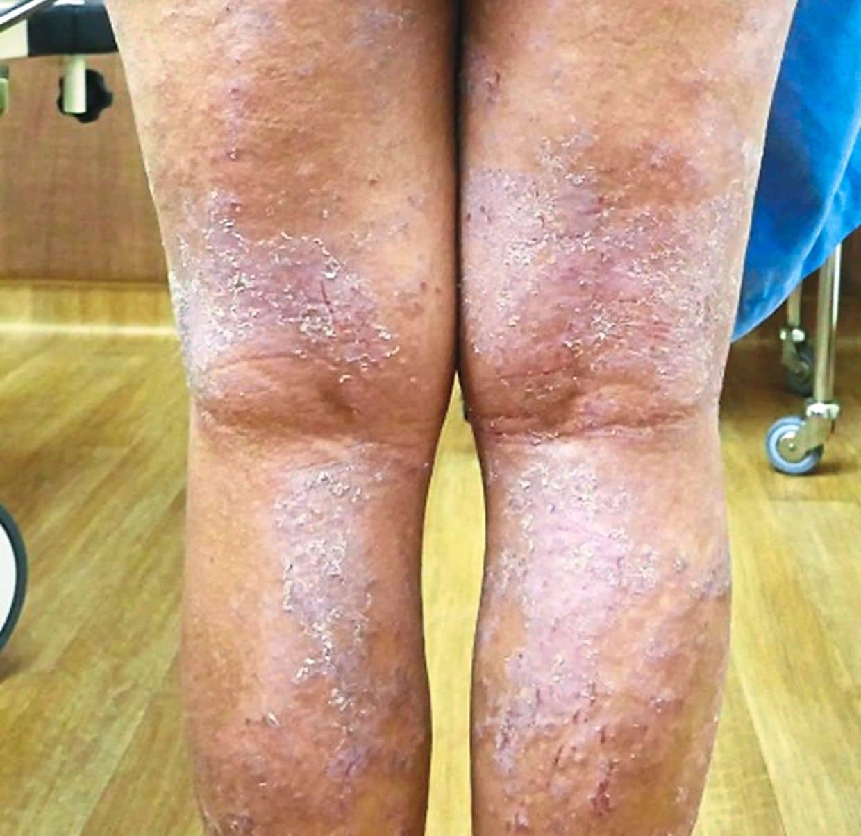 A new treatment for atopic dermatitis or eczema
