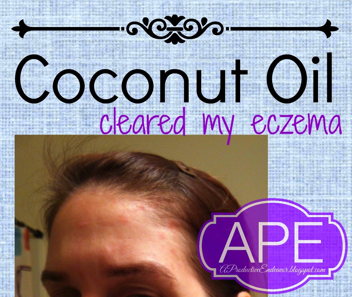 A Productive Endeavor: Coconut oil &  seborrheic dermatitis