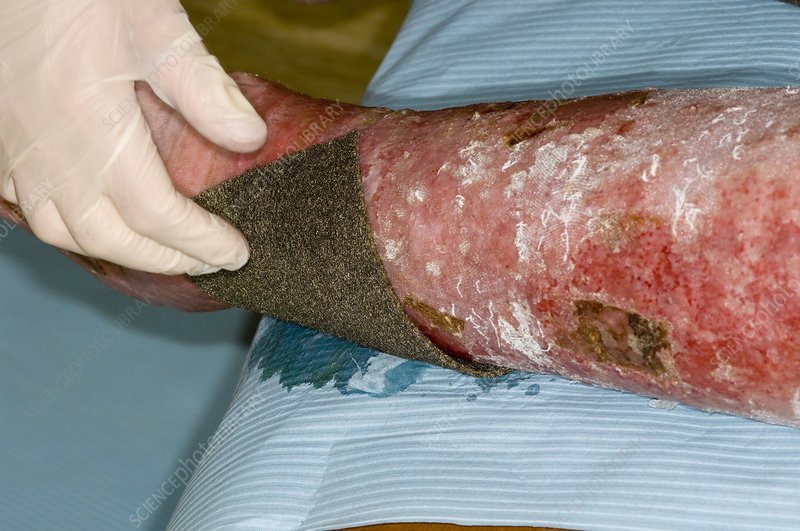 Acticoat treatment of varicose eczema