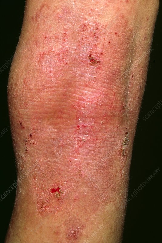 Acute eczema seen on the leg of 12 year