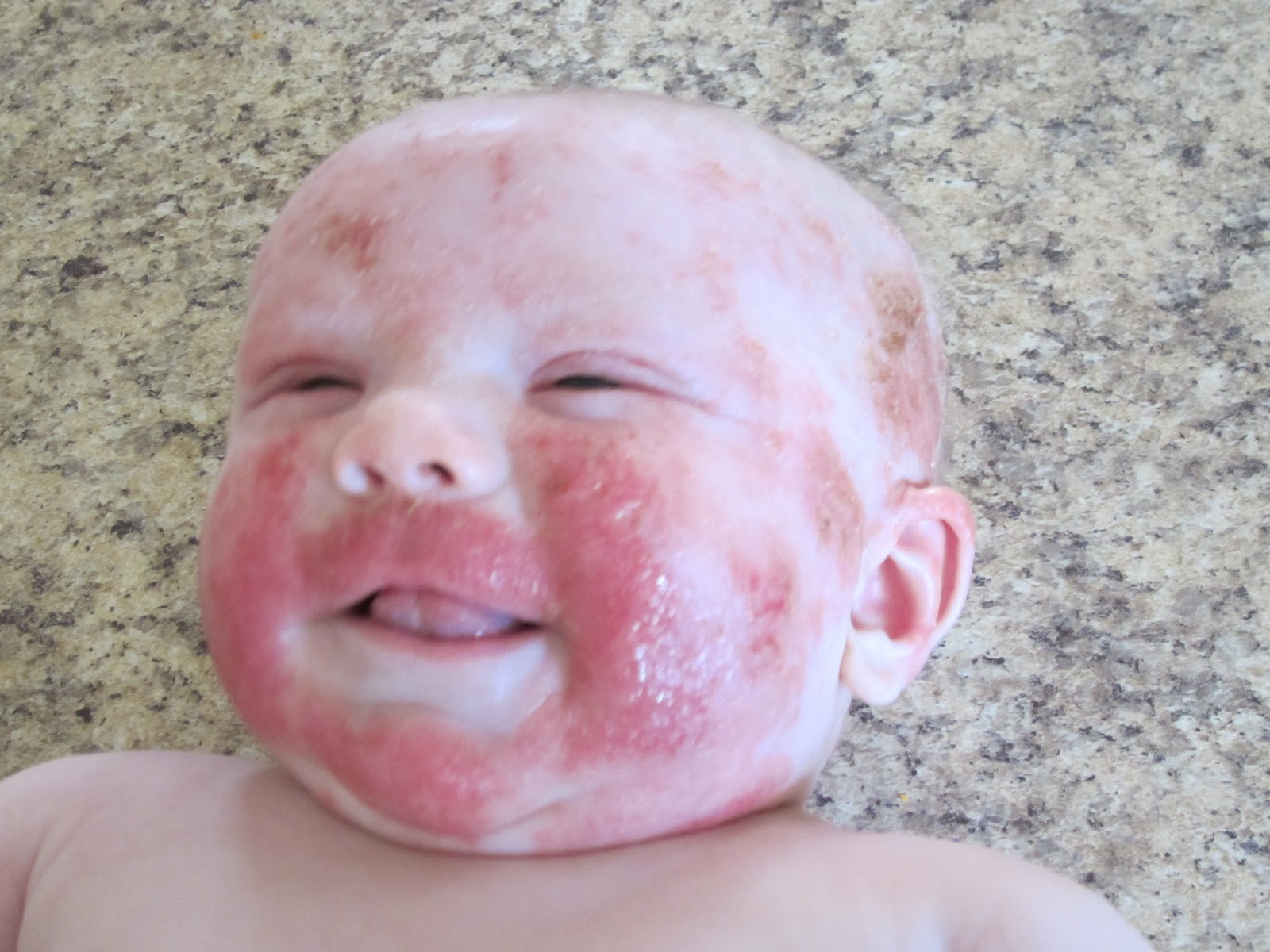 Adams Family: Severe Allergy Induced Eczema On My Infant.