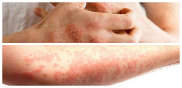 Adult Onset Eczema: Causes, Symptoms, and Treatments  Hoool Health ...