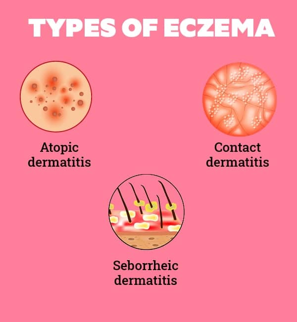 All You Need to Know About Eczema on Face