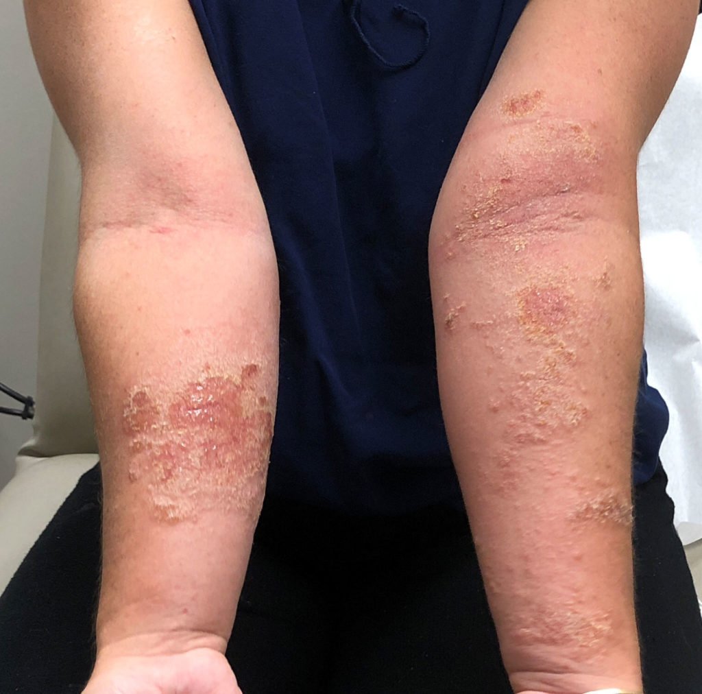 Allergic Contact Dermatitis Causes : Ways to Treat Eczema ...