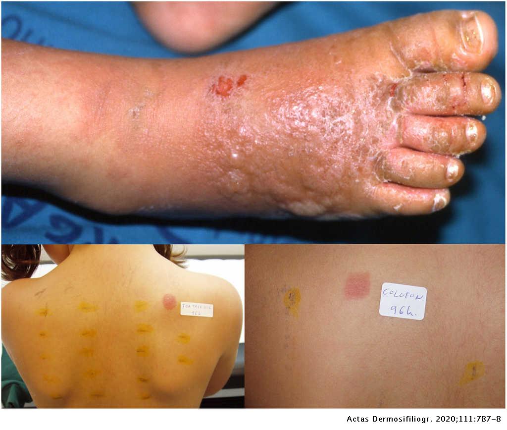 Allergic Contact Dermatitis Due to Tea Tree Oil