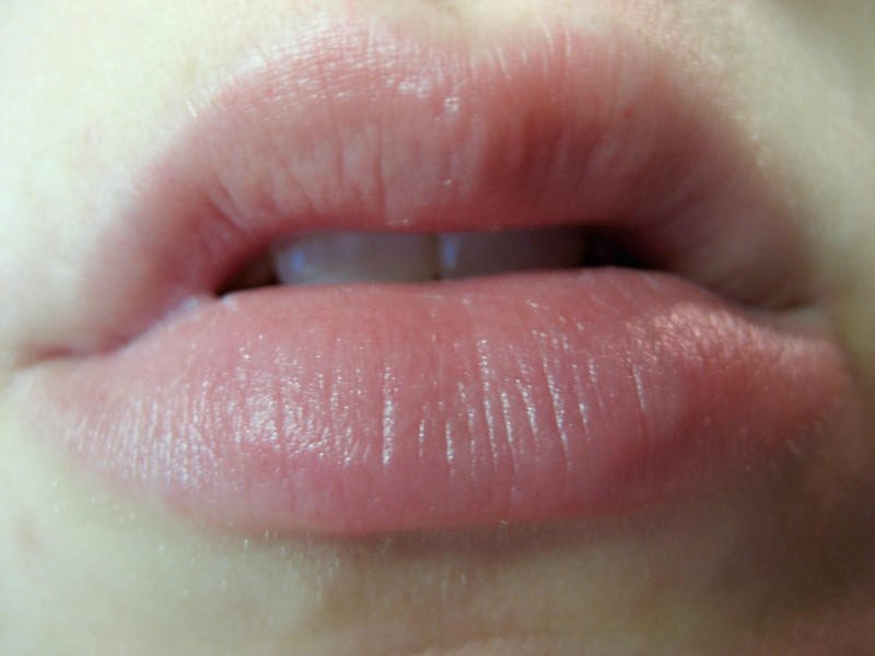 Allergic Reaction On Lips: Lip Allergy Treatment ...