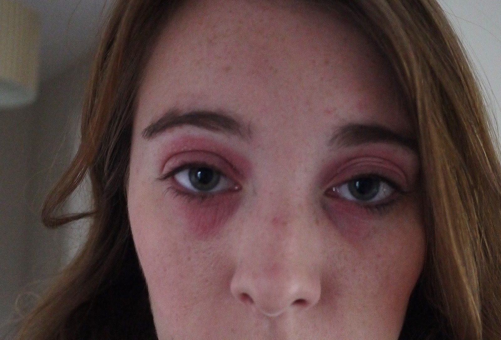 Allergic Reaction To Makeup Under Eyes