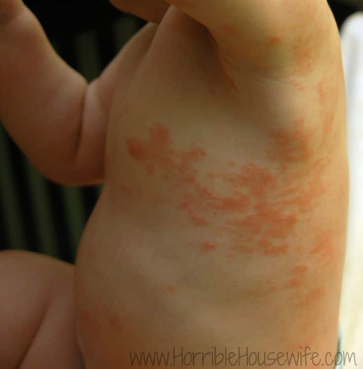 Allergy Test for Toddler Eczema