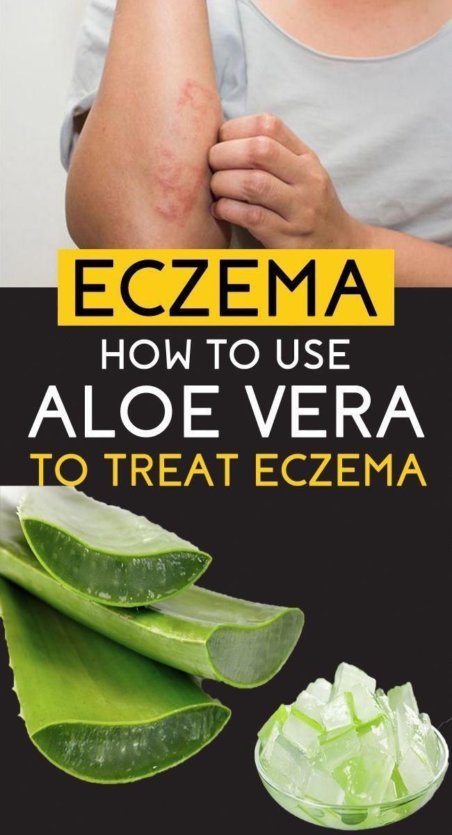 Aloe vera gel  &  eczema in 2020