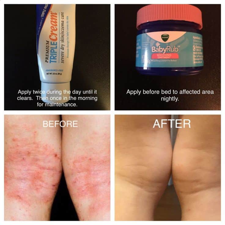 AMAZING RELEIF FOR ECZEMA!!!!! Hoping this helps anyone else affected ...