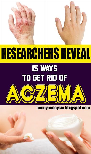 Analysts Reveal 15 Ways To Get Rid Of Eczema