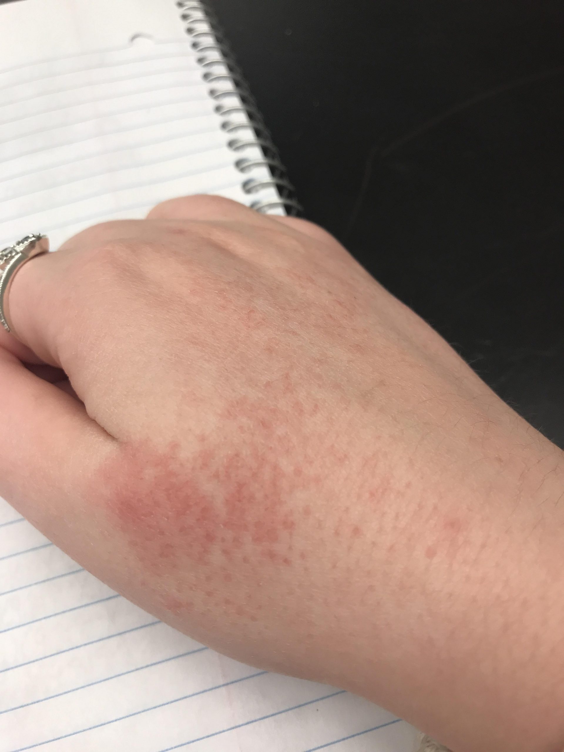 Anyone else getting eczema like this on their hands? is ...