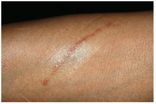 Approach to the Patient with Dermatitis