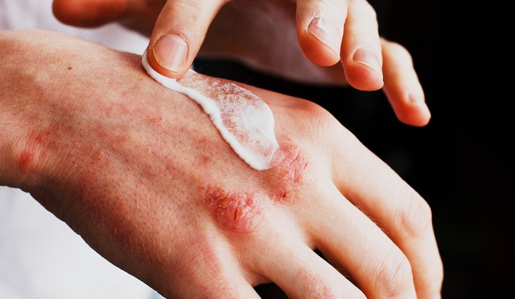 Approaches to Eczema Management