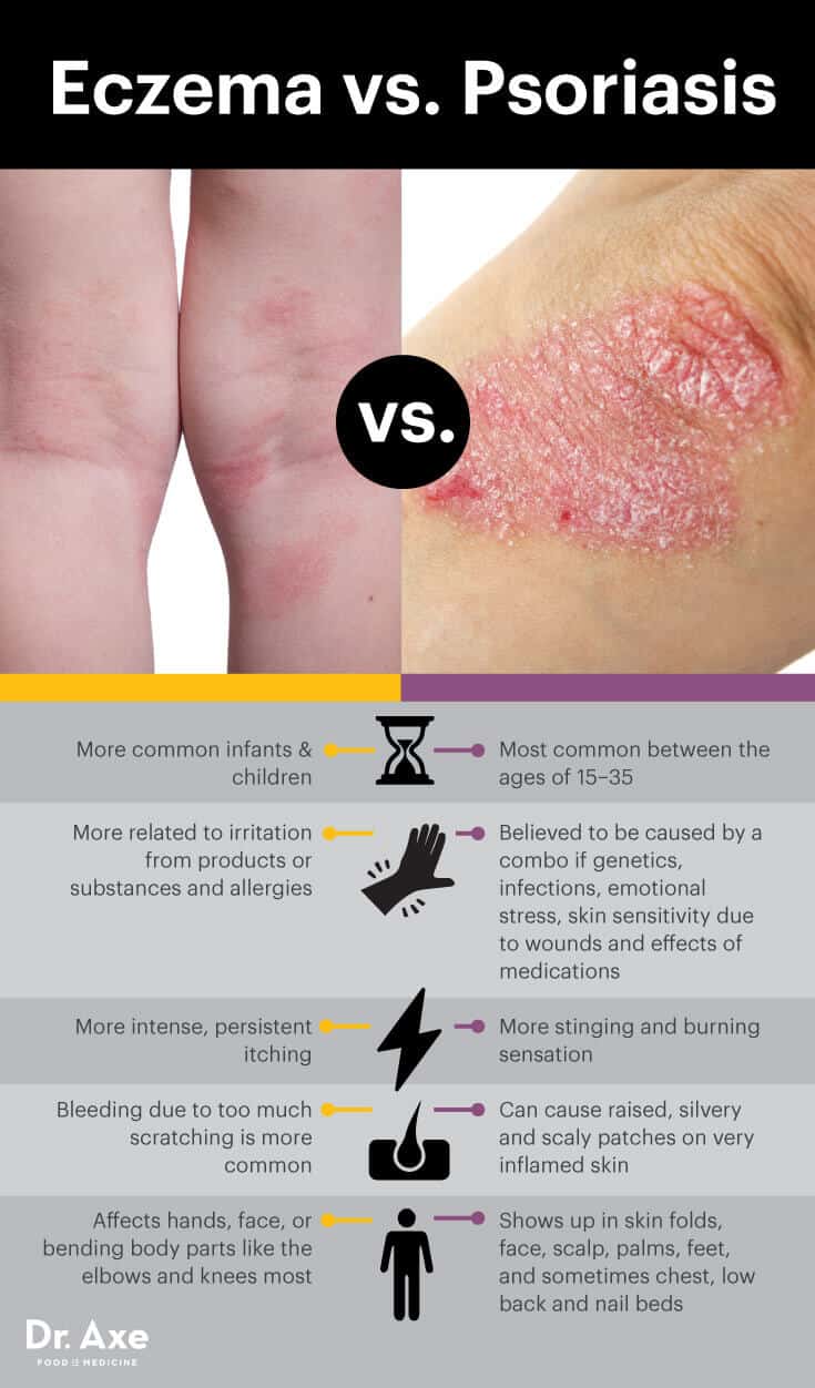 Are you experiencing eczema symptoms? Here are 5 natural ...