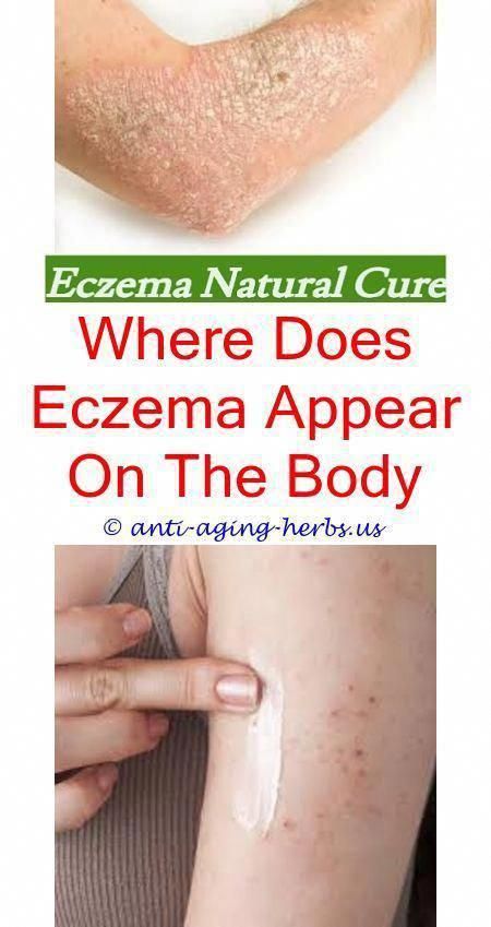 Are you struggling with eczema? Are you seeking expert facts on the ...