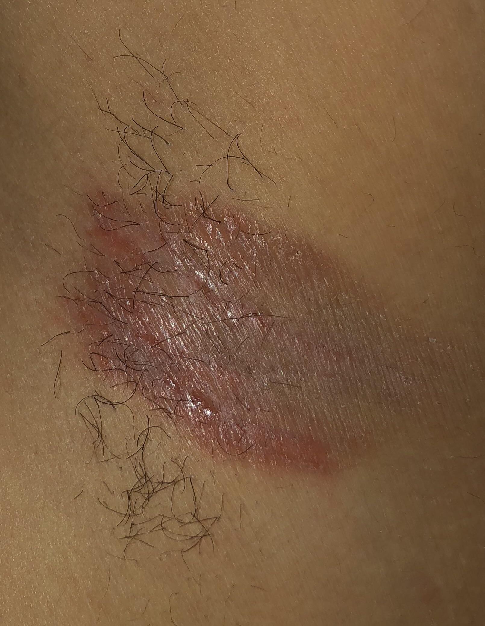 Armpit rash is at its worse. I
