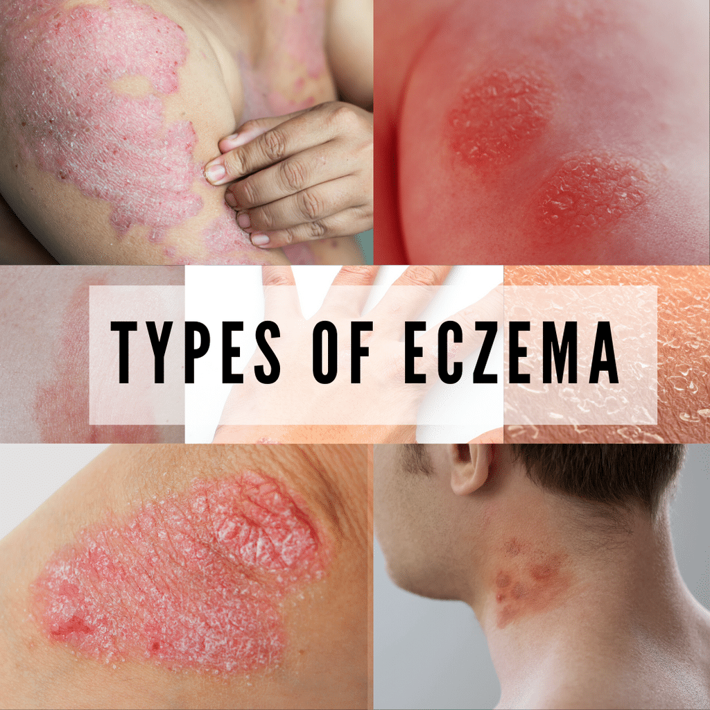 â eczema types on face 613188
