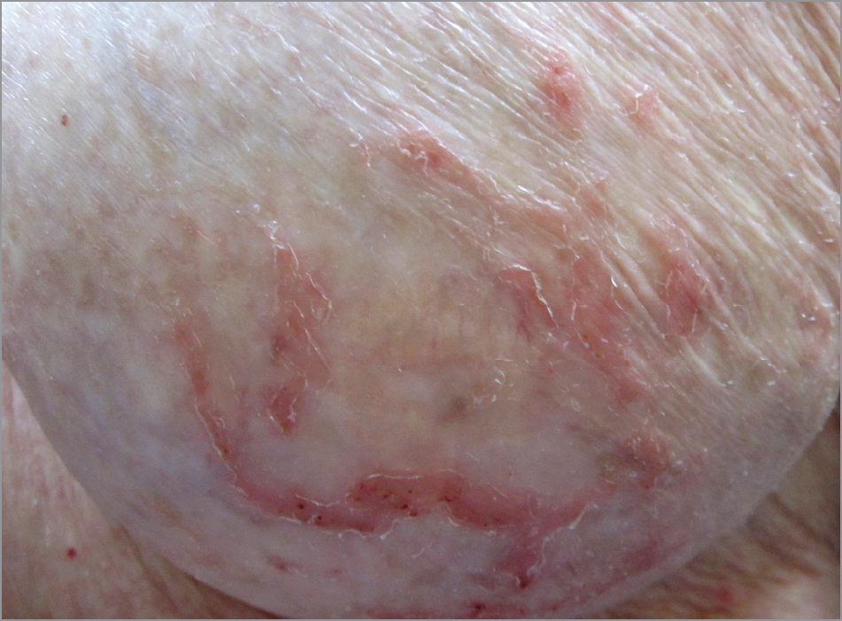 Asteatotic Eczema in Hypoesthetic Skin: A Case Series