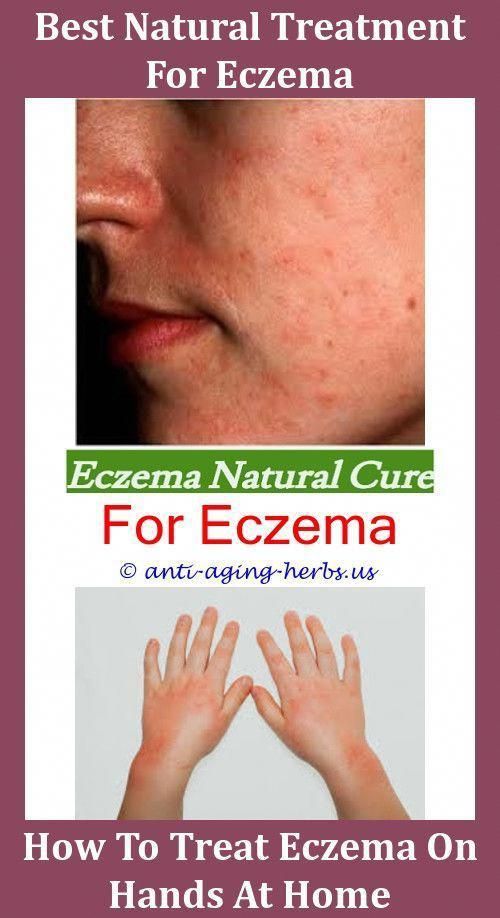 Athletes Foot Cream For Eczema,cause eczema holistic remedies for ...