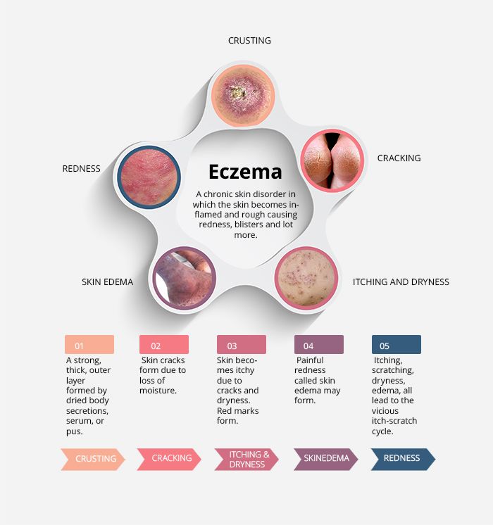 Atopic Dermatitis  Eczema Infographic  Interesting Facts
