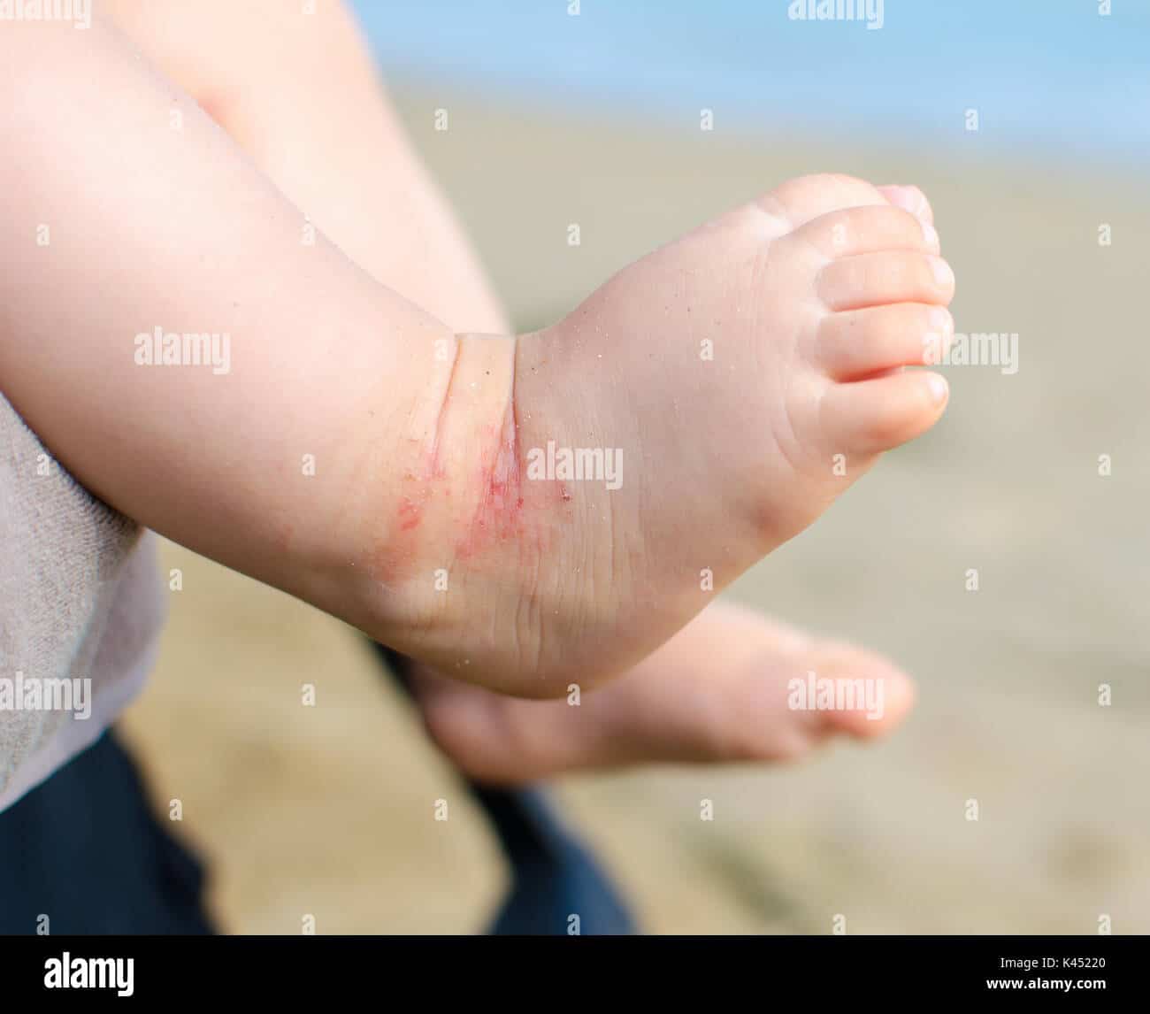 atopic dermatitis newborn feet eczema Stock Photo: 157463320