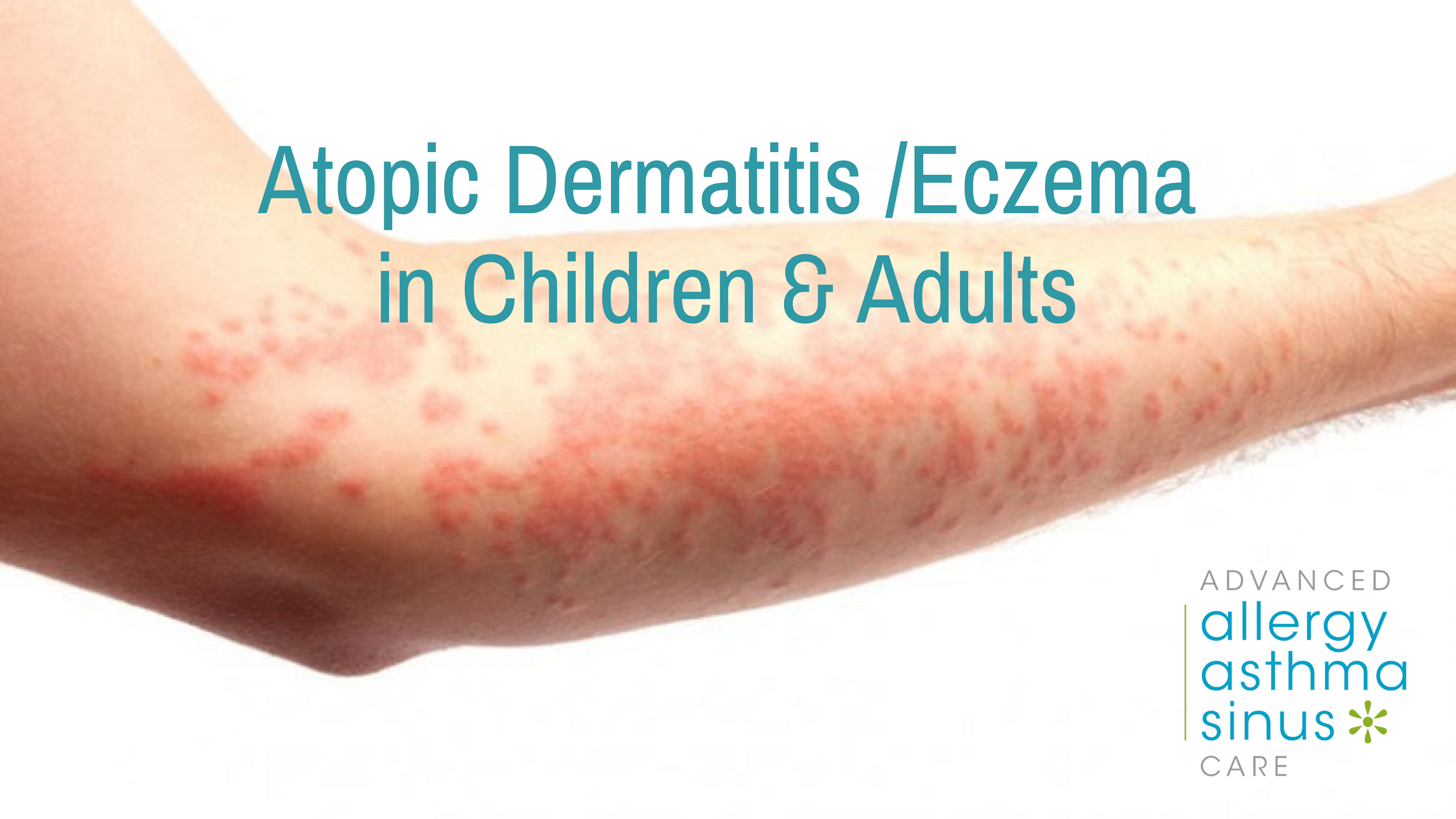 Atopic Dermatitis/Eczema in Children &  Adults